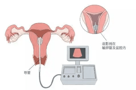 试管婴儿胚胎移植后要注意些什么？