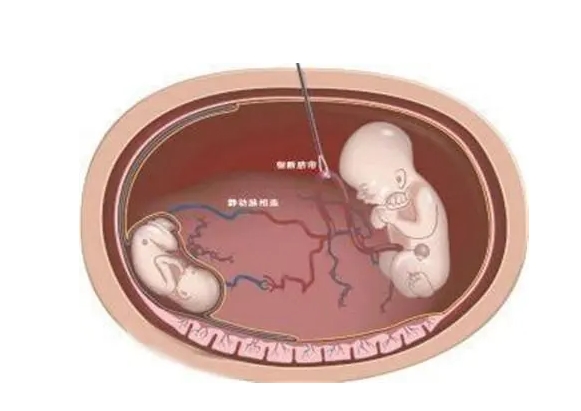 哈萨克斯坦试管成功案例，哈萨克斯坦试管婴儿成功故事